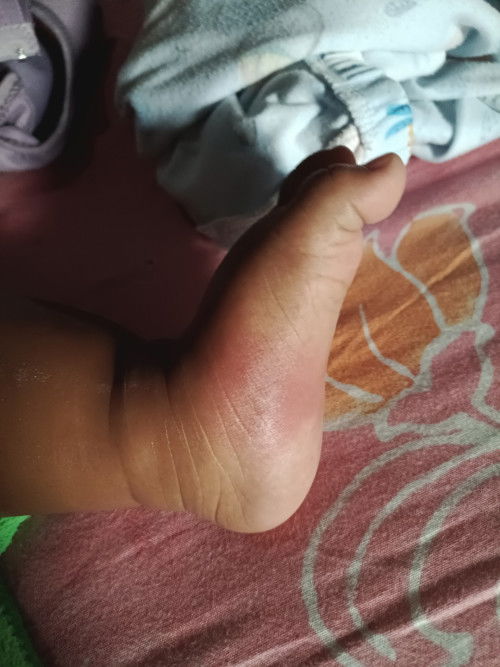 Telapak kaki merah dan badannya langsung panas