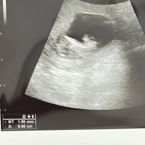 ukuran NT umur kehamilan 11w3d