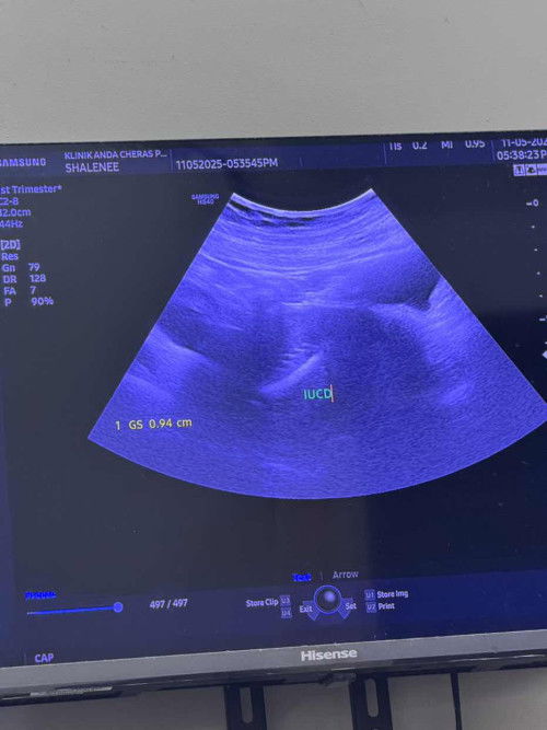 IUCD PREGNANT