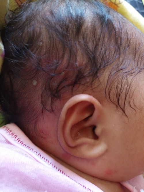 Babyku kulit lehernya ruam dan kepalanya banyak bisul dan cacar
Udah ke dokter tapi belum sembuh
