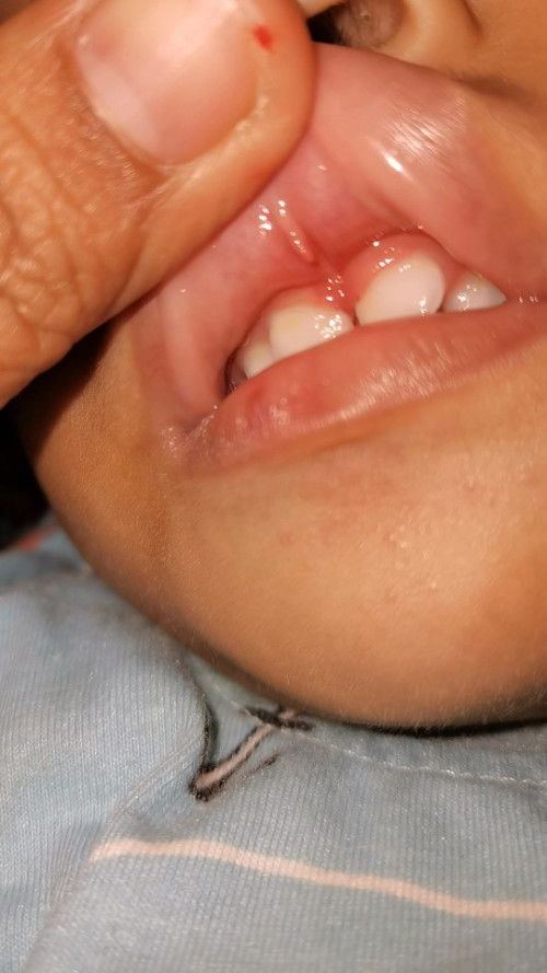 Anak ku jatuh, terus lip tie nya putus, itu gapapa kan moms?
Darah nya banyak tapi sudah berhenti.