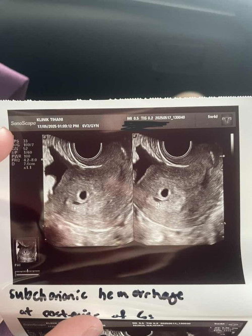 Subchorionic hemorrhage