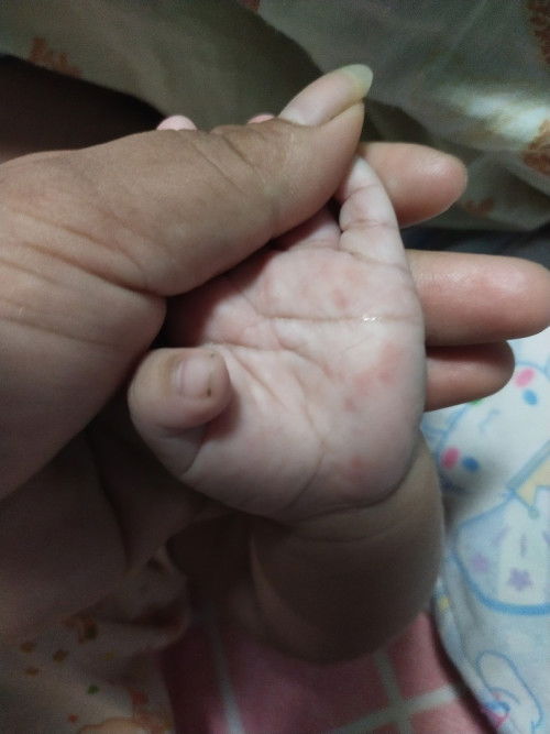 ตุ่มแปลกๆที่มือเด็ก