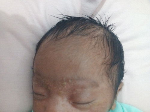 Sakit kulit oada bayi