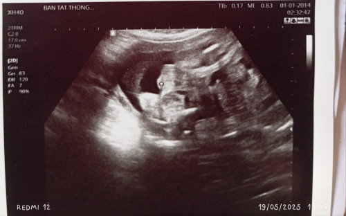 27w+4 หมอว่าผช ไข่น้องที่ลูกสอนชี้ไม่น่าใช่ผญใหญ่ขนาดนี้
เเม่ๆช่วยดูให้หน่อยว่าว่าชัวไหมค่ะ