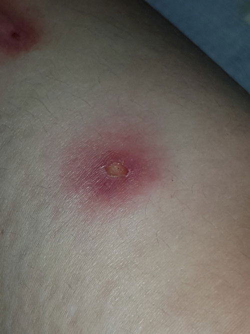 Luka bintik, 2 hr kemudian disekitarnya warna merah