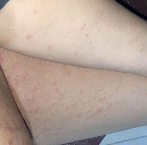 Ada yg ngalamin gatel” kyk aku gk bun
