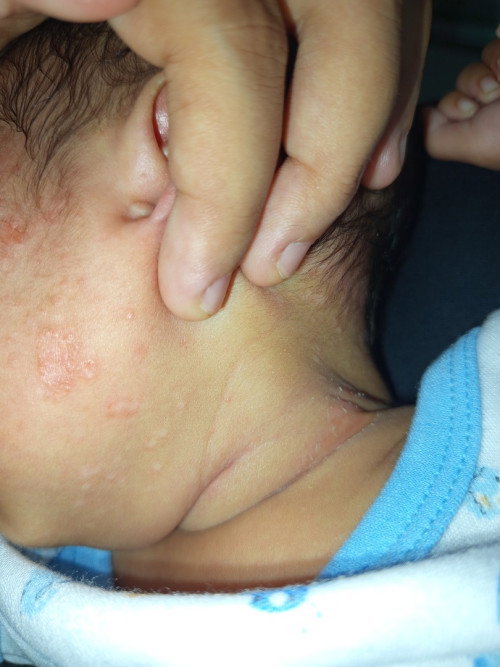 Ada ruam di leher dan juga bintik putih di pipi sampai belakang telinga.
