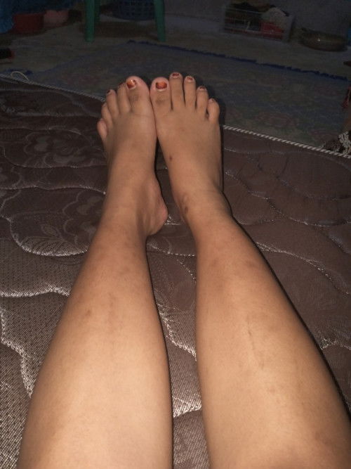 33 wekk udh sakit smua kaki,🥹