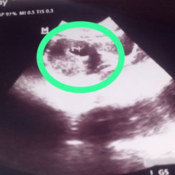 Tolong bantu jelasin ya Bun.. apa ini Dede bayi nya ?? Kehamilan 10 Minggu