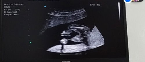 18 weeks na po kami ni baby ko, sa tingin nyo po baby girl or baby boy?
