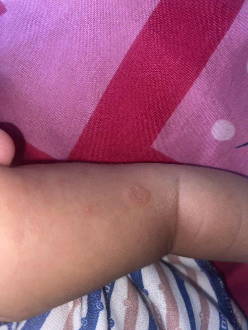 Apakah ini psioriasis??