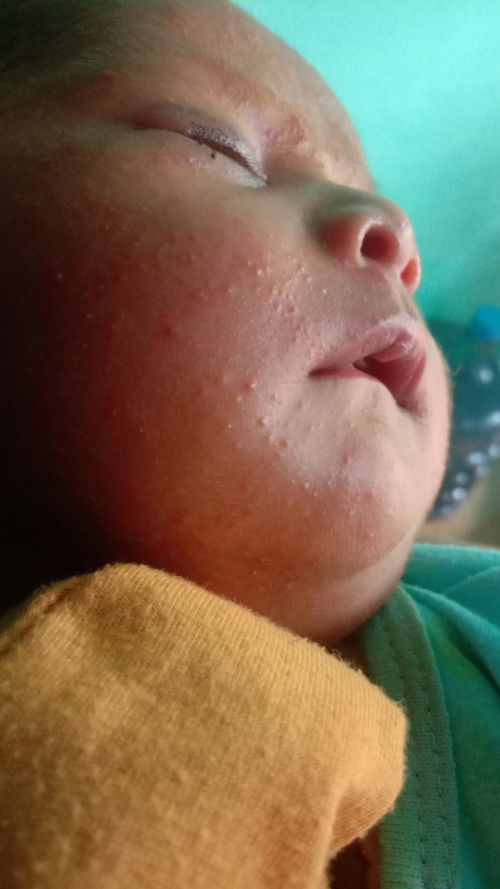 Beruntusan merah pada wajah baby 19 hari 
Recommended dong yg bnr" ampuh
