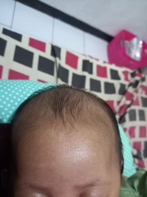 Bagaimana cara menghilangkan bekas biangkeringat yg menjadi putih