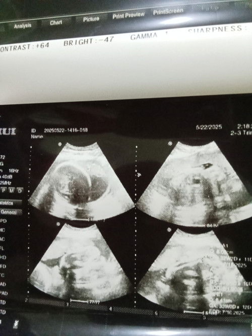 Bayi melintang pada Minggu ke 31