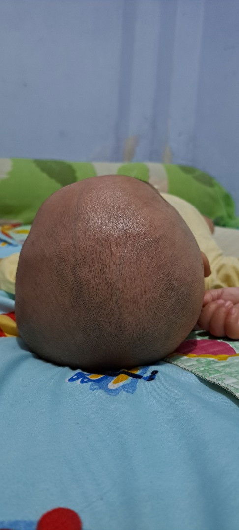 Kepala peyang atau normal
