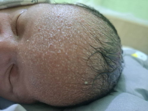 Jidat beruntusan pada bayi