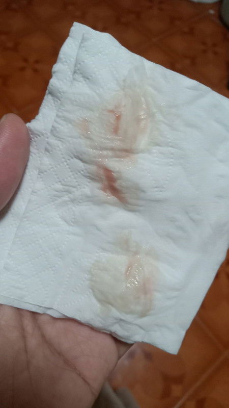 หลังตรวจปากมดลูกมูกเลือดออกกี่วัน