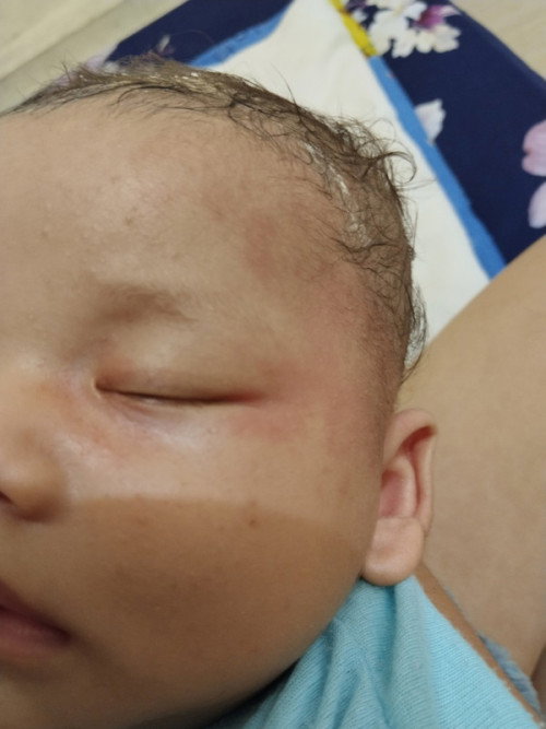 Merah merah pada kulit bayi