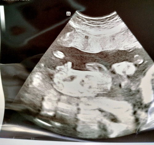Boy or girl