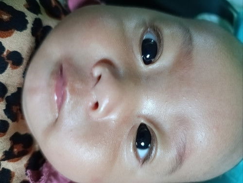 Bruntusan pada bayi
