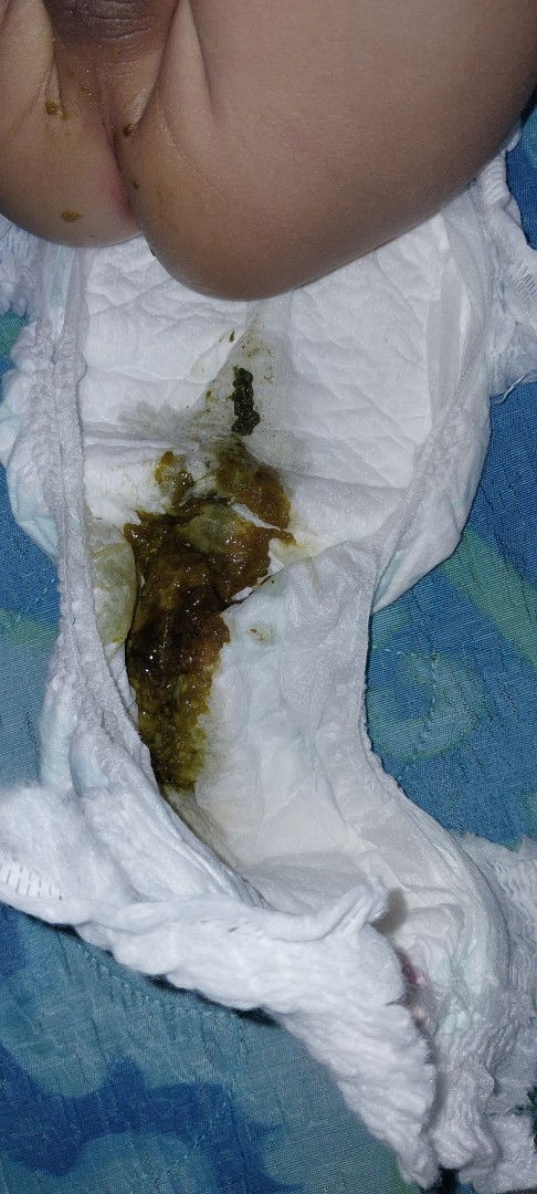 Bun bayi 7 bulan pup nya begini kira2 knp ya Bun,,terus makannya juga susah, sehari pup 5kali