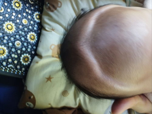 Kenapa ya bun dahi anak saya jdi kayak gini ,muncul setelah 5 hari lahir,awal lahir mah gak ada 🥹