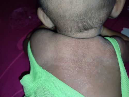 Gatal/ruam merah di belakang leher dan punggung