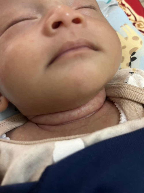 Bun ada gk yang baby ya keringat buntet seperti ini , ini memang pemulihannya lama gk