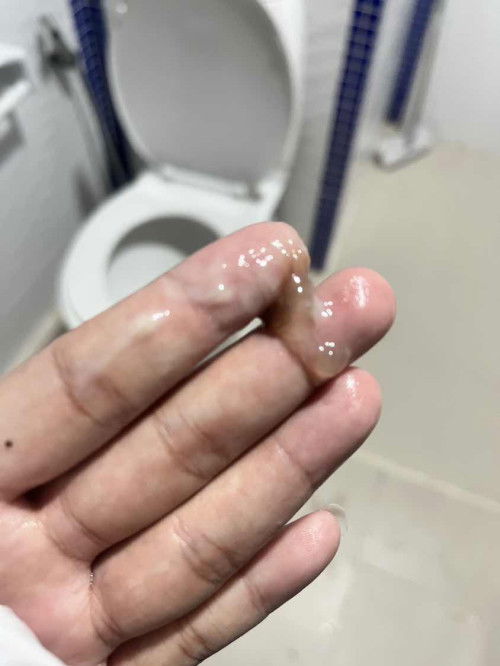 ท้อง34สัปดาห์มีมูกสีนำ้ตาลเป็นมา3วันแล้วเกิดจากสาเหตุอะไรคะมีใครเคยเป็นบ้าง