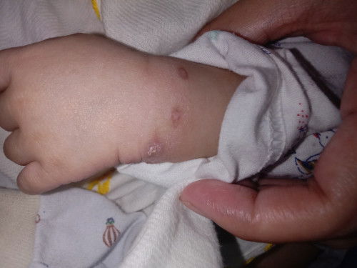 Tangan baby benjol bernanah