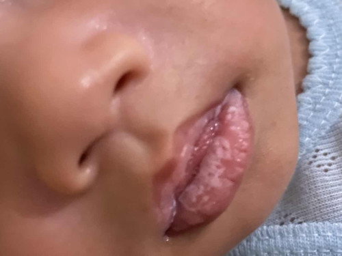 Putih putih di bibir hilangnya gimana ya?