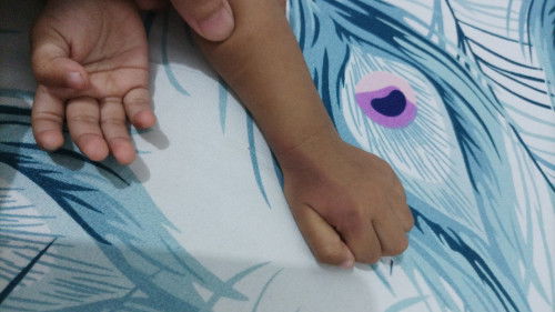 Cara ngilangin bekas luka