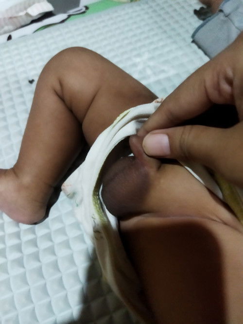 webbed penis