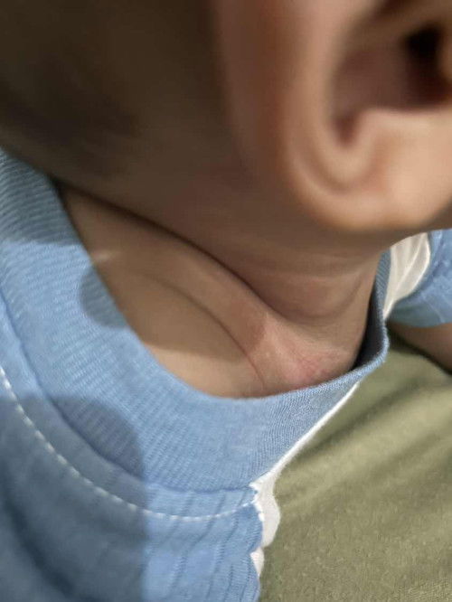 Kulit bayi tbtb merah dan ada warna putihnya