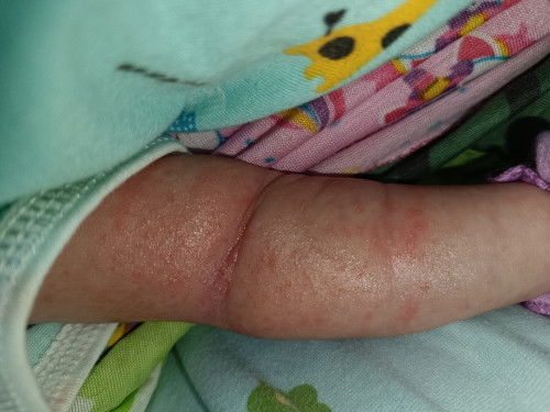 Bintik2 kemerahan
