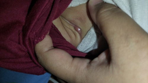 Benjolan kecil di ketiak