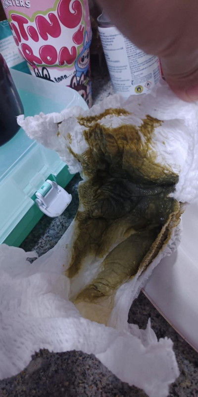 อึสีแบบนี้ปกติไหม