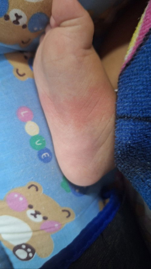 มีผื่นแดงขึ้นรอบเท้า