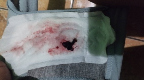 Flek ke 2x ( bercak darah segar minggu lalu - hari ini keluar darah lagi + sedikit gumpalan )