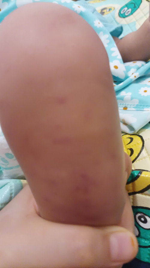 ruam di kaki bayi