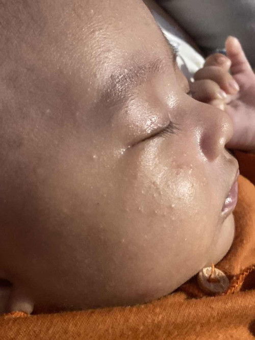 Jerawat/beruntusan di wajah bayi