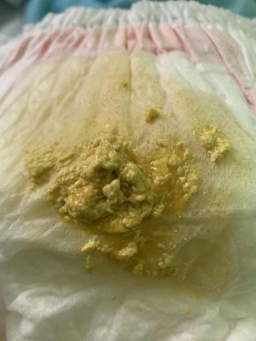 เด็ก1เดือนอึแบบนี้ปกติมั้ยค่ะมีเลือดปนมาจุดนึงเล็กๆค่ะ