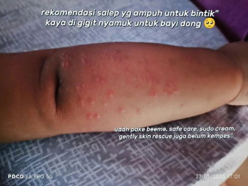 Recomendasi salep yg ampuh untuk bayi 10 bulan alergi seperti yg di foto,yg ampuh pake apa ya bunda"