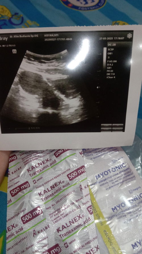 Keguguran di 7 minggu