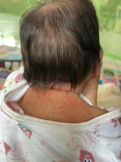 ผื่นแบบนี้ในเด็กทารก