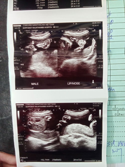 อัลตร้าซาวด์