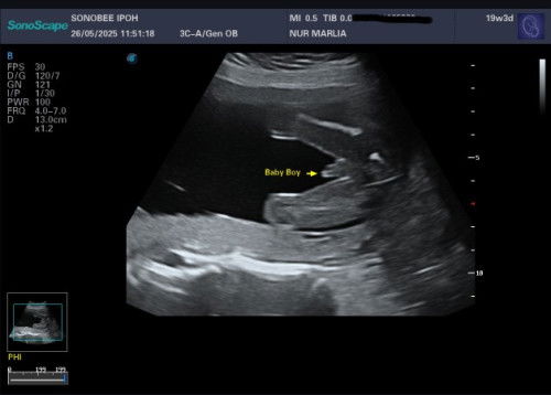 Scan gender 19weeks