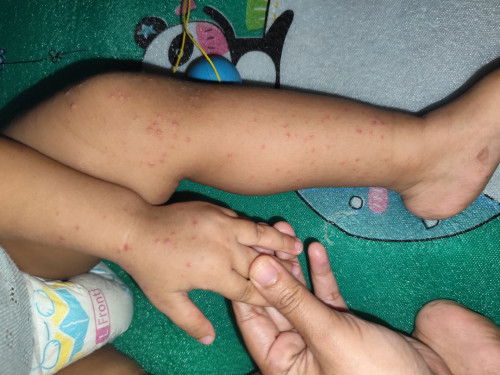 Muncul bintik-bintik kecil merah setelah anak demam, gatal, rewel