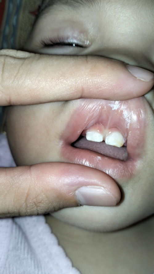 Gusi anak seperti terangkat keatas